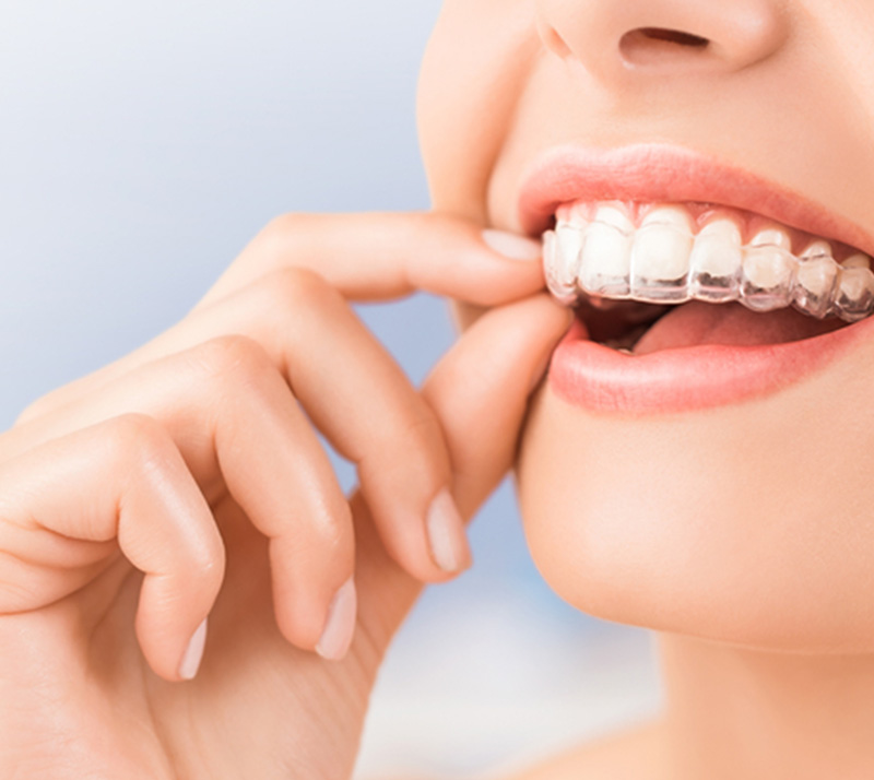 Invisalign-2 Dr. Peter Servinis